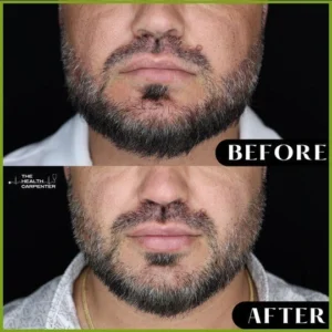 Before and After Treatment Images | The Health Carpenter in Orlando, FL