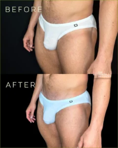Penis filler Before & After Images in Orlando, FL