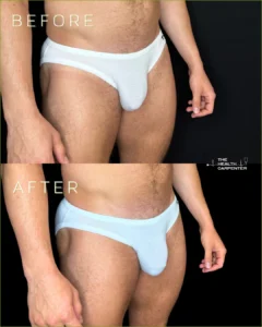 Penis filler Before and After Images in Orlando, FL