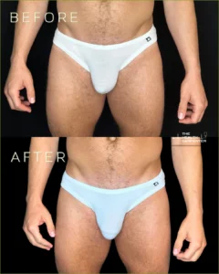 Penis fillerBefore and After Images in Orlando, FL