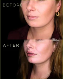Lip filler 1