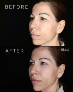 Lip filler 2