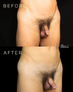 Before and after results of male groin skin tightening treatment